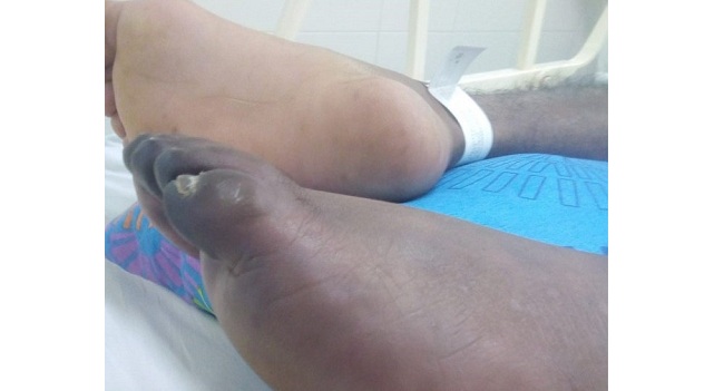 Todavía Kleiderman David Ponce Calderón, espera ser intervenido para ver si sale de este trance.