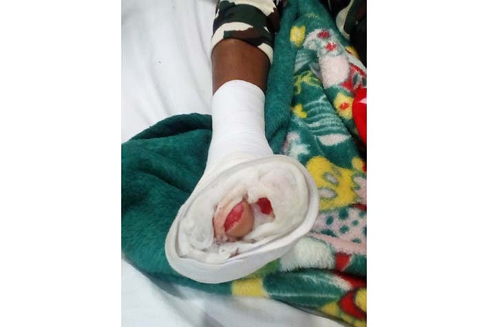 Este menor de 8 años fue remitido a la Clínica Asocabildo, después que fuera afectado por una línea de conducción eléctrica en el suelo